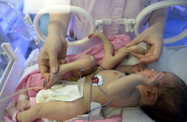 عمل جراحی روی نوزادِی که دارای چهار دست و چهار پا است