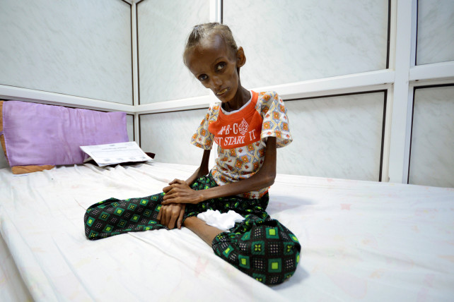 سوء تغذی شدید دختر 18 ساله یمنی